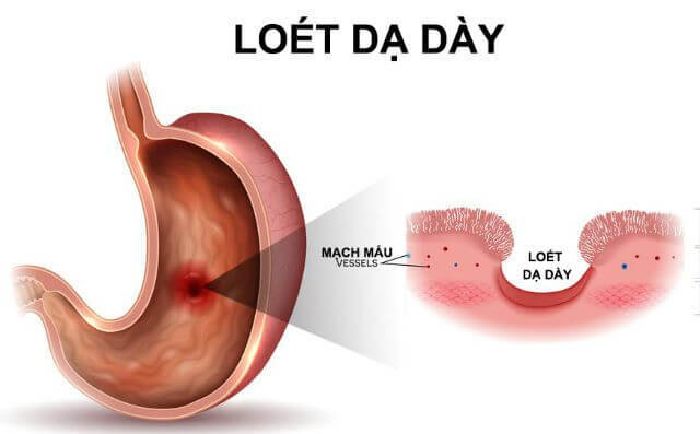 Dạ dày viêm loét