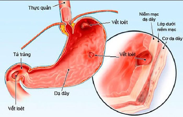 Loét Dạ Dày
