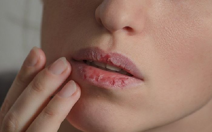 Người khó ngủ, môi khô