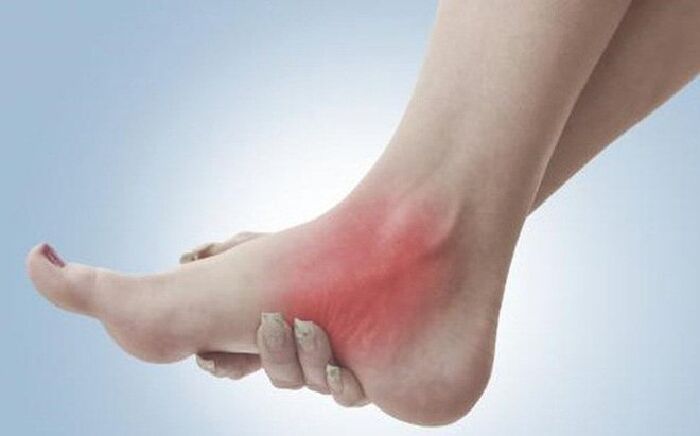Người bị sai khớp hoặc bong gân