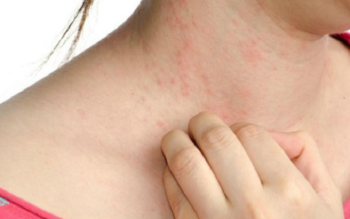 Sốt xuất huyết có ngứa
