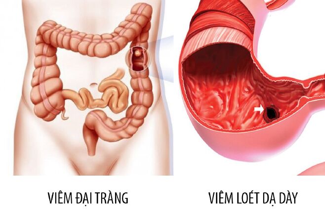 Đại tràng hay dạ dày bị viêm