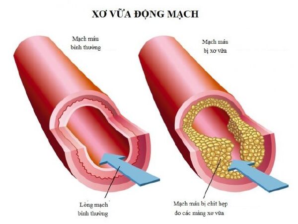 Người bị động mạch xơ cứng