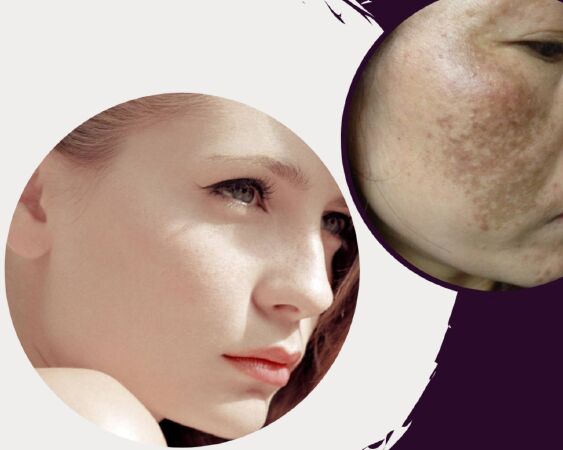 Làm trắng và làm giảm nám sạm da