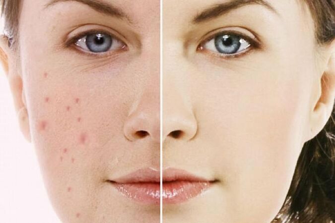 Trị mụn, trị thâm hiệu quả