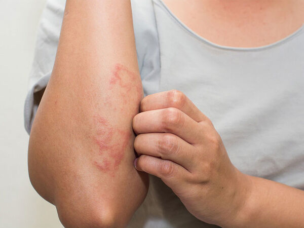 Điều trị bệnh chàm