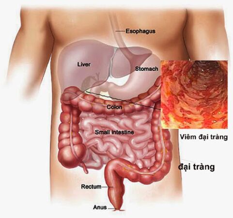 Bệnh đại tràng