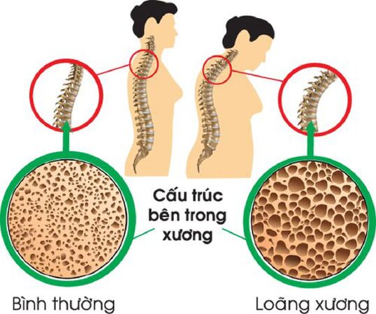 Phòng chống loãng xương