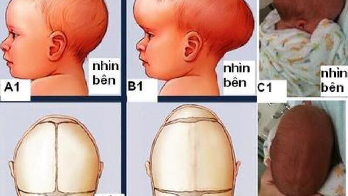 Thóp lâu liền, xương khớp biến dạng