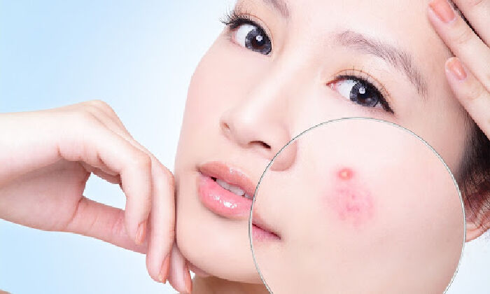 Trị mụn và dưỡng trắng da hiệu quả