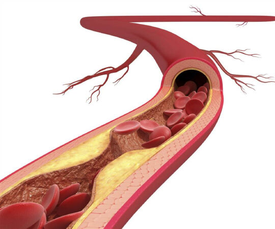 Giảm cholesterol và xơ cứng động mạch