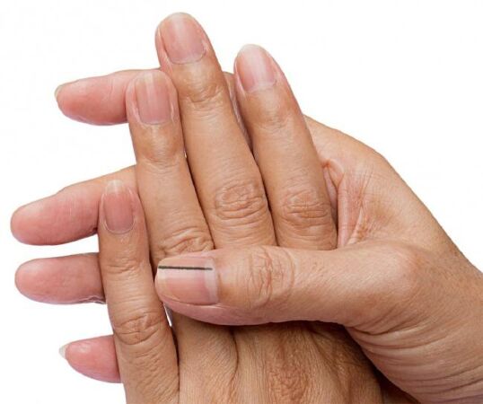 Đường màu đen trên móng tay
