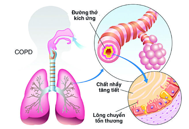 Có thể tử vong do hệ hô hấp bị cản trở