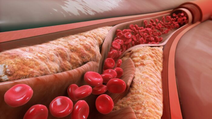 Hạ cholesterol trong máu
