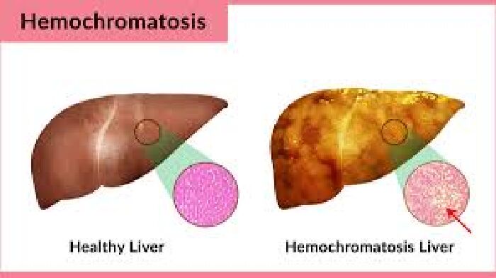 Bệnh Hemochromatosis