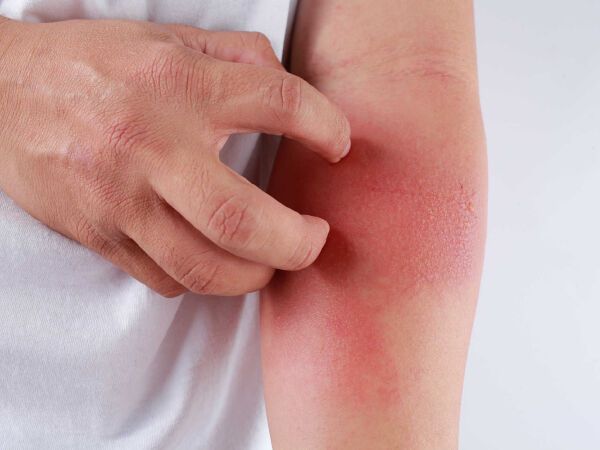 Có tác dụng chống viêm