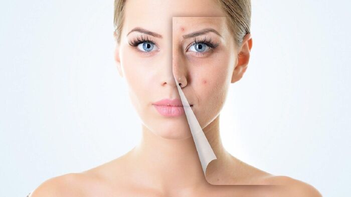 Giảm và ngăn ngừa mụn trứng cá