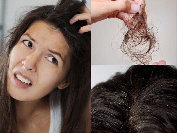 Ngăn ngừa gàu và rụng tóc