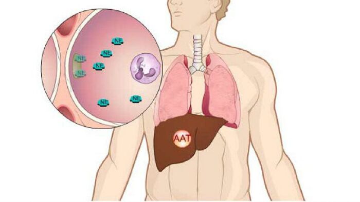 Thiếu hụt Alpha-1 Antitrypsin
