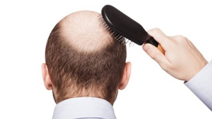 Trị rụng tóc, ngăn ngừa hói đầu