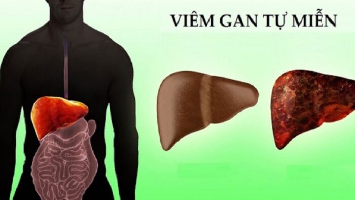 Viêm gan tự miễn