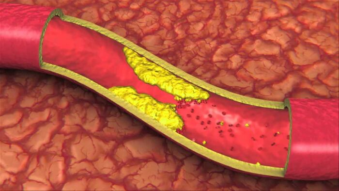 Giảm cholesterol