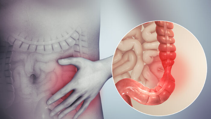 Giảm tình trạng ruột kích thích