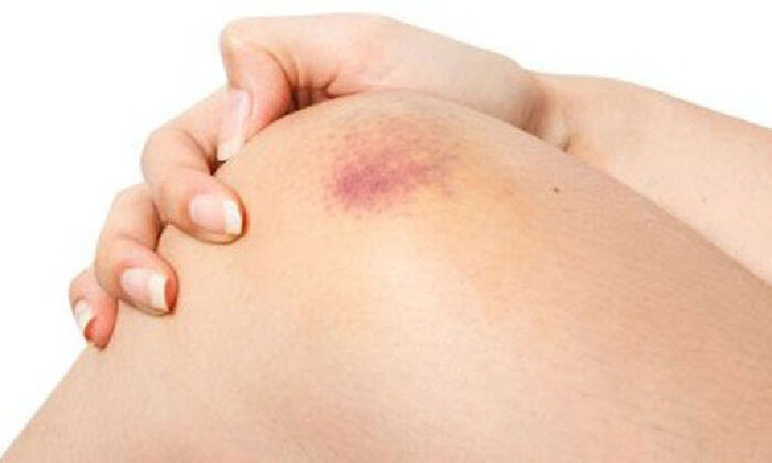 Giúp chữa lành các vết bỏng và vết bầm tím