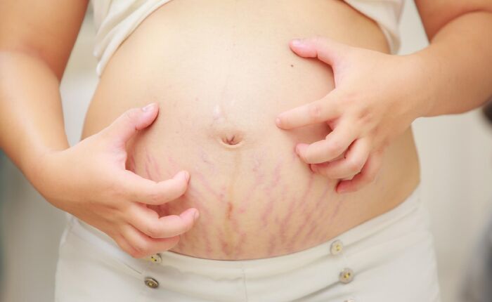 Giúp làm giảm các vết rạn da