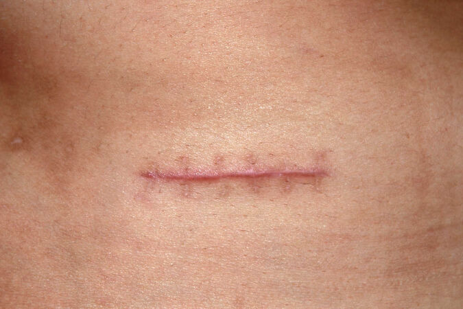 Làm mờ các vết sẹo