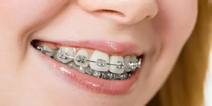 Thế nào là niềng răng?