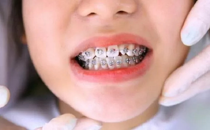 Niềng răng đã có từ 300 năm trước