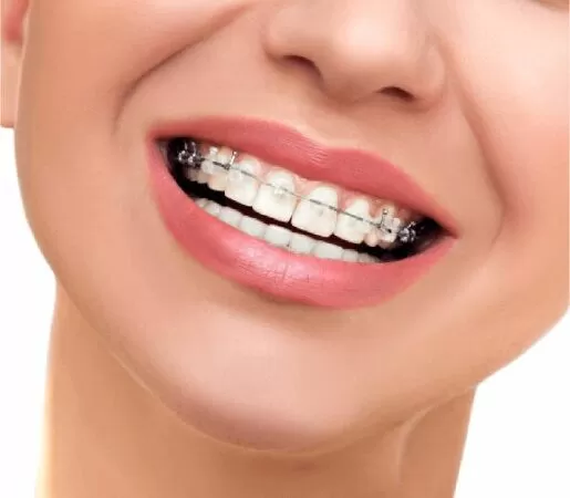 Dây thép dùng cho niềng răng được phát minh bởi NASA