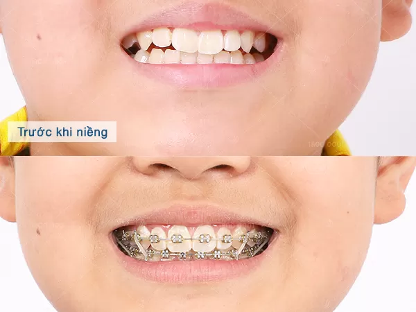 Niềng răng không chỉ giúp làm thẳng hàm răng của bạn