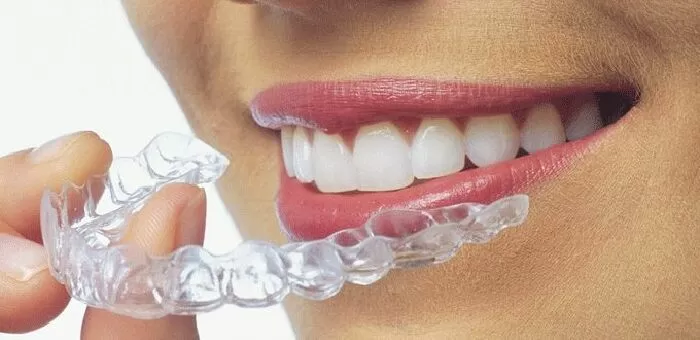 Có hơn mười loại niềng răng khác nhau