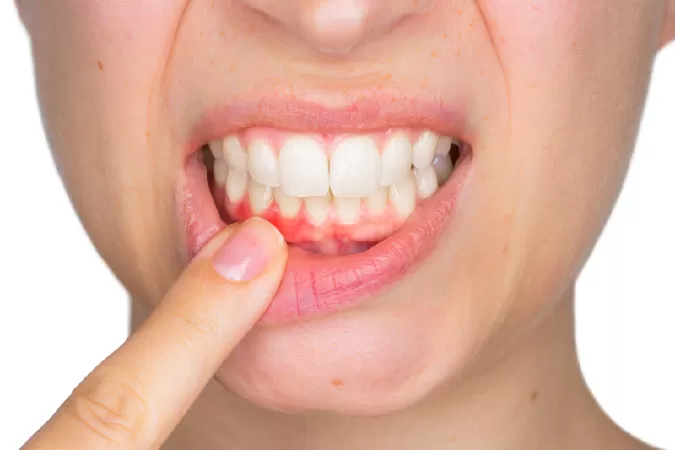 Một số lầm tưởng về niềng răng