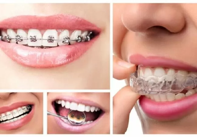 Tại sao phải niềng răng lâu như vậy?