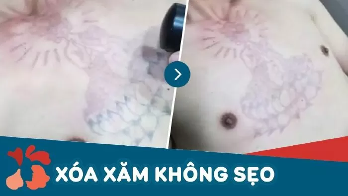 Địa chỉ xóa xăm tại Hà Nội - Kang Nam