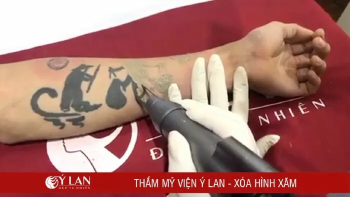 Địa chỉ xóa xăm tại Hà Nội - Ý Lan