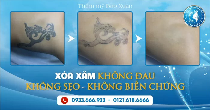 Địa chỉ xóa xăm tại Hà Nội - Bảo Xuân