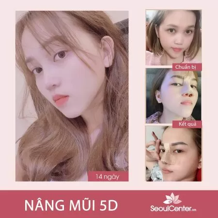 Top 10 địa chỉ nâng mũi đẹp và uy tín nhất TP HCM