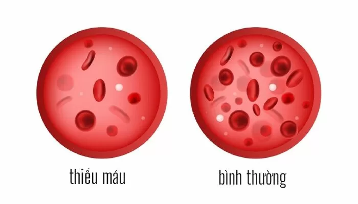 Tìm hiểu xem bạn có bị thiếu máu không
