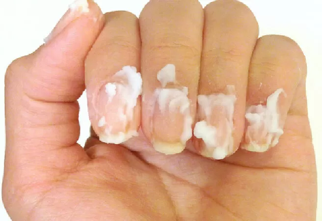 Trị nấm móng