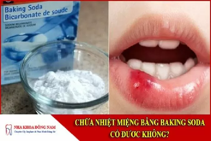 Trị loét miệng