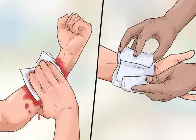 Tạo áp lực bằng tay khi sử dụng băng gạc