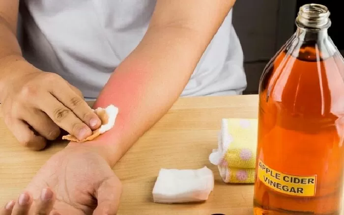 Chữa vết cháy nắng