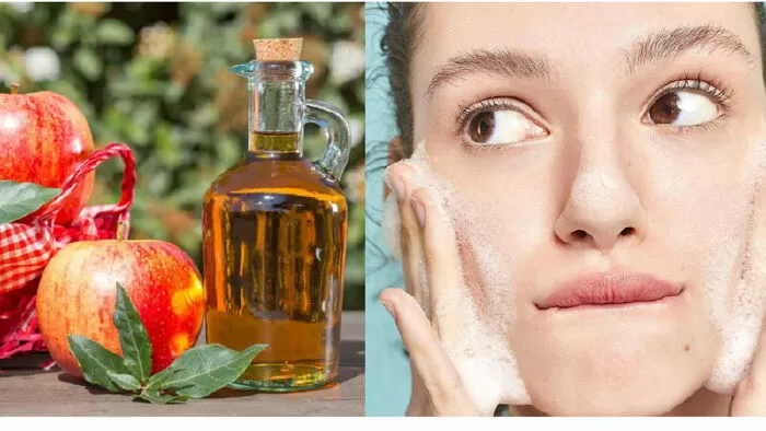 Điều trị mụn trứng cá và vết thâm