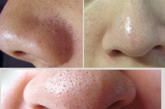 Hỗ trợ điều trị mụn đầu đen