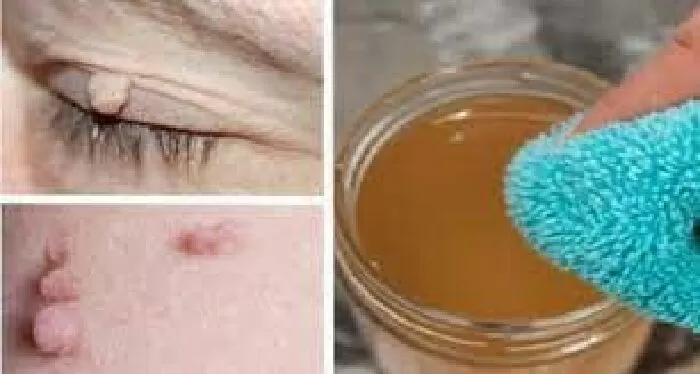Điều trị mụn cóc trên da