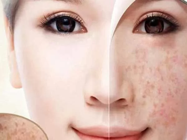 Top 14 Địa chỉ trị nám không thể bỏ qua Tại Hà Nội
